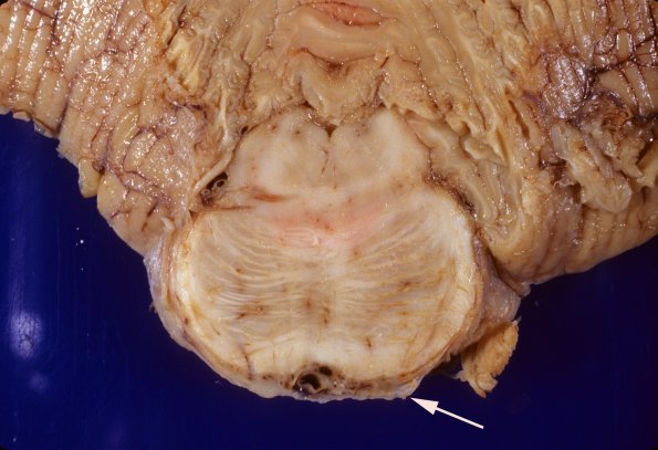 3A5 TB Meningitis (Case 3) gross 9 copy