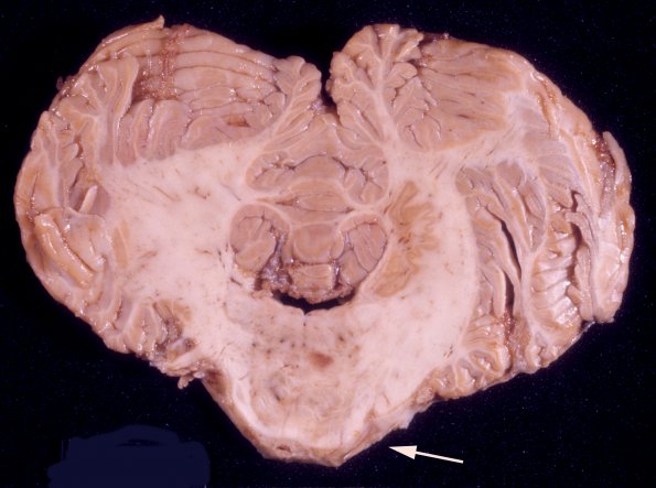 3A6 TB Meningitis (Case 3) A8 copy