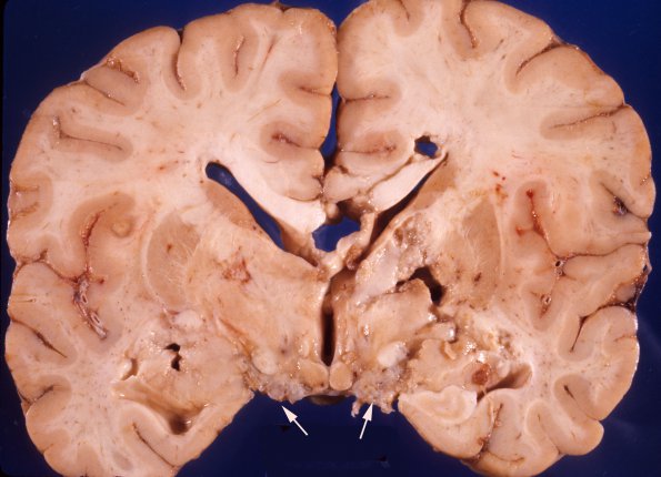 3A7 TB Meningitis (Case 3) gross 10 copy