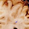 3A8 TB Meningitis (Case 3) gross 6 TB granuloma copy