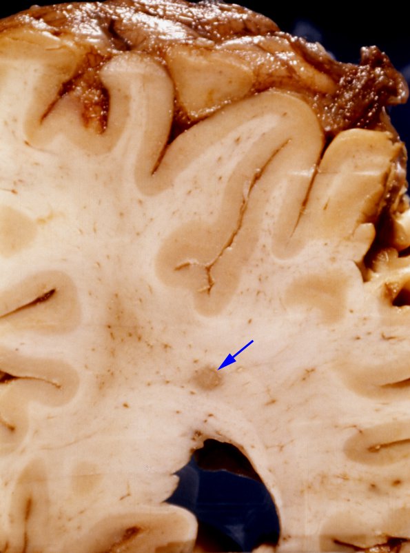 3A8 TB Meningitis (Case 3) gross 6 TB granuloma copy