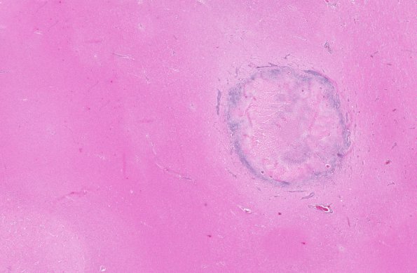 3B1 TB, tuberculoma (Case 3) H&E whole mount