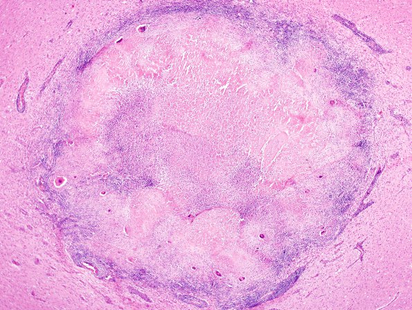 3B2 TB, tuberculoma (Case 3) H&E 4