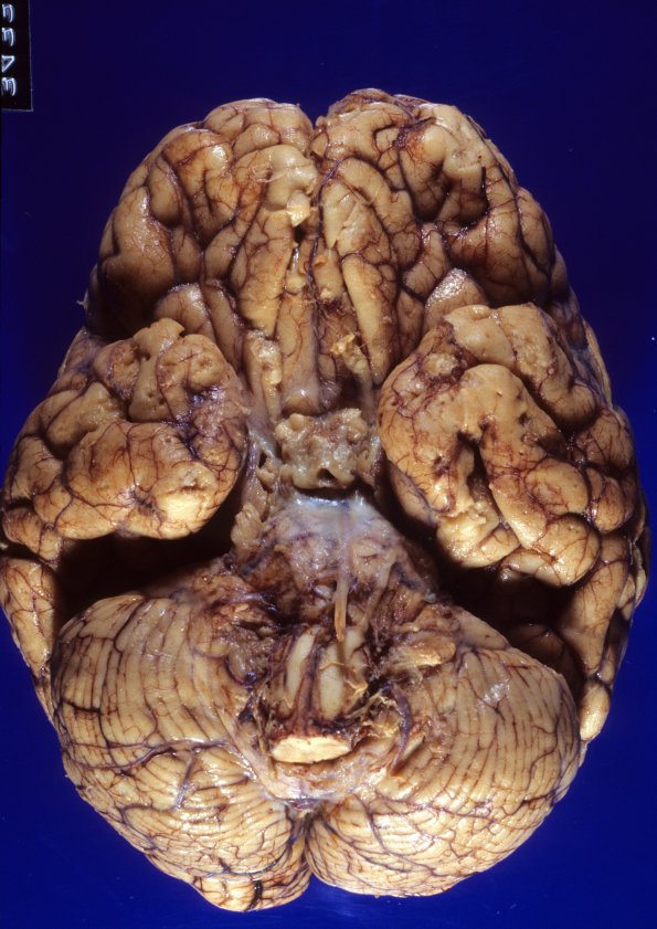 4A1 TB Tuberculoma (Case 4) 2