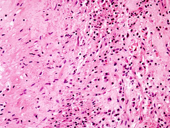 4B5 TB Abscess (Case 4) H&E 4