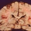 4C1 TB Tuberculoma (Case 4)