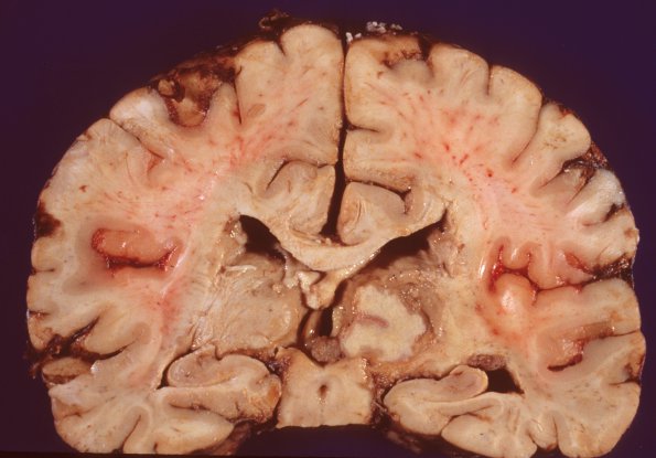 4C1 TB Tuberculoma (Case 4)