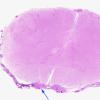 4D1 Abscess (Case 4) H&E A whole mount copy