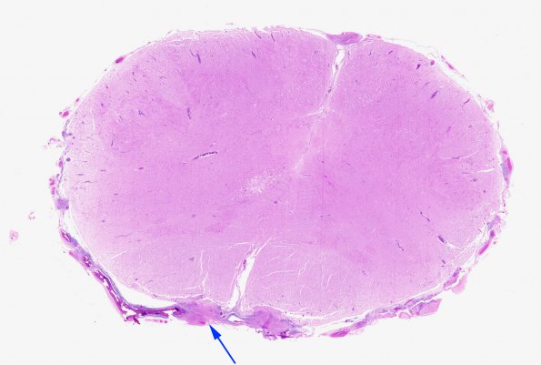 4D1 Abscess (Case 4) H&E A whole mount copy