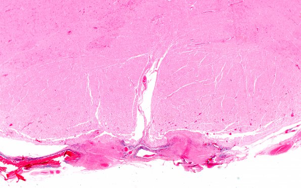 4D2 Abscess (Case 4) H&E A 11