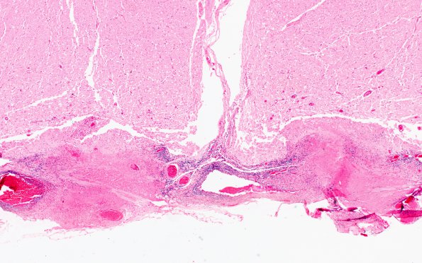 4D3 Abscess (Case 4) H&E A 10