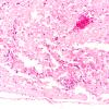 4D5 Abscess (Case 4) H&E A 2