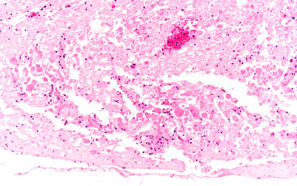 4D5 Abscess (Case 4) H&E A 2