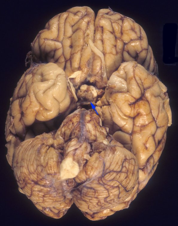 5A1 TB Meningitis (Case 5) 5 copy