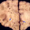 5A2 TB Meningitis (Case 5) 4 copy