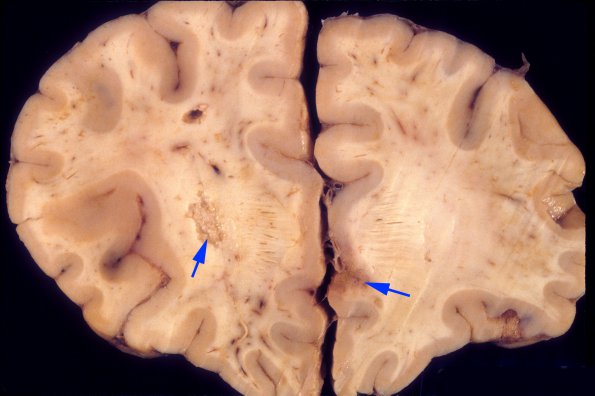 5A2 TB Meningitis (Case 5) 4 copy