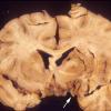 5A3 TB Meningitis (Case 5) 7 copy