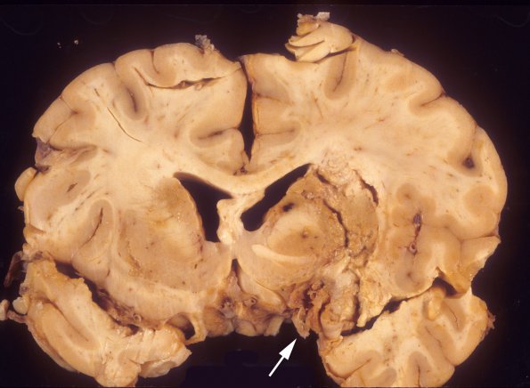 5A3 TB Meningitis (Case 5) 7 copy