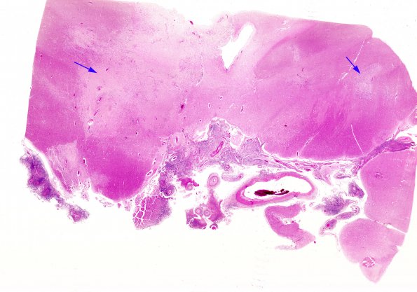 5B1 TB Meningitis (Case 5) H&E 2 copy