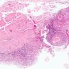 5B2 TB Meningitis (Case 5) 1