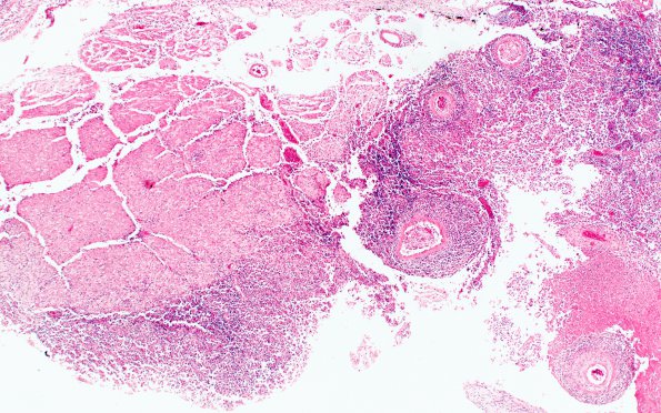 5B2 TB Meningitis (Case 5) 1