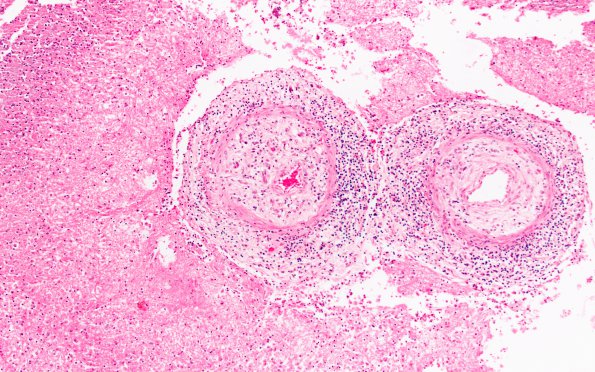 5B3 TB Meningitis (Case 5) 4