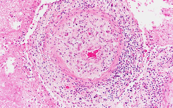 5B4 TB Meningitis (Case 5) 5