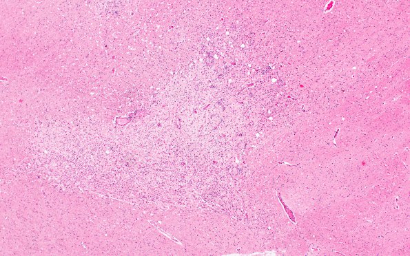 5B6 TB Meningitis (Case 5) 2A