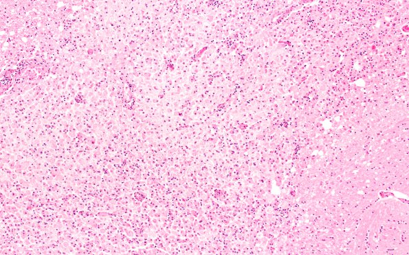 5B7 TB Meningitis (Case 5) 3