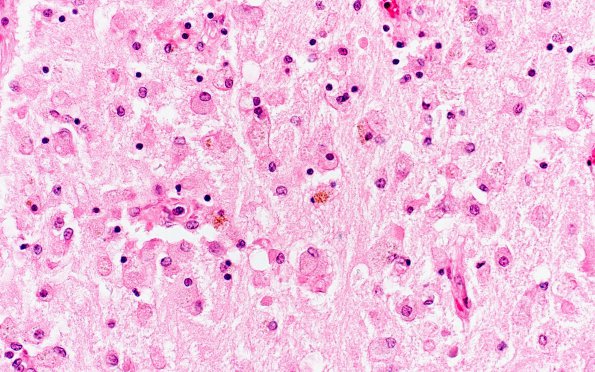 5B8 TB Meningitis (Case 5) 7