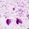 6B TB Tuberculosis (tuberculoma, Case 6) H&E smear 3A