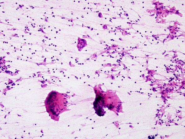 6B TB Tuberculosis (tuberculoma, Case 6) H&E smear 3A