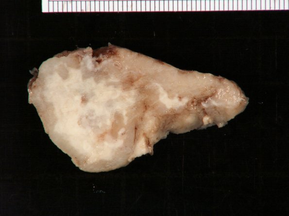 6C TB Tuberculosis (tuberculoma, Case 6) Gross _1