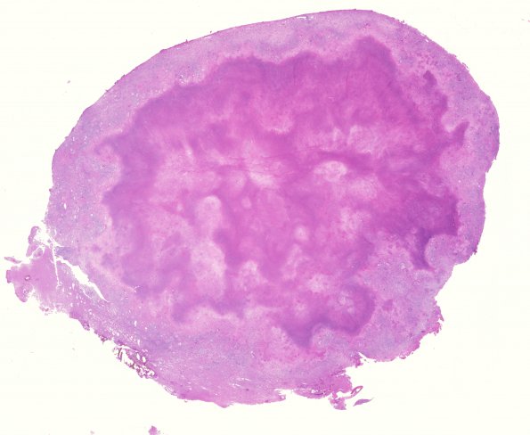 6D1 TB Tuberculosis (tuberculoma, Case 6) H&E whole mount