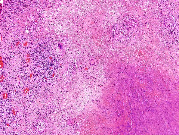 6D4 TB Tuberculosis (tuberculoma, Case 6) H&E 6