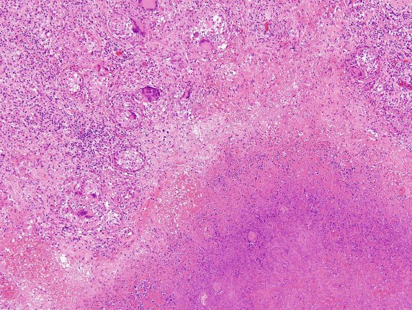 6D5 TB Tuberculosis (tuberculoma, Case 6) H&E 8