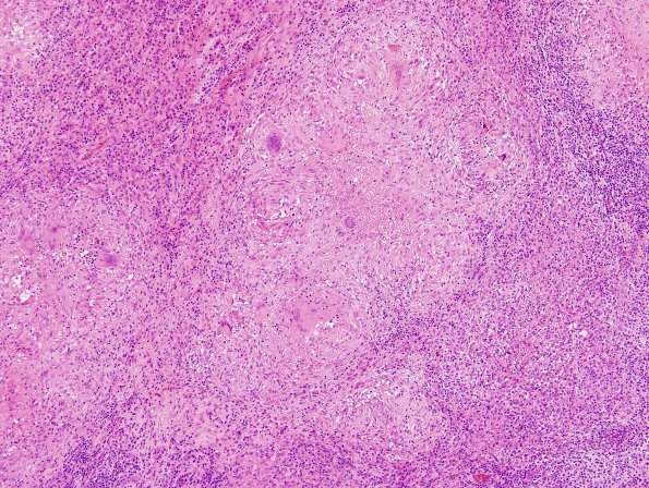 6D6 TB Tuberculosis (tuberculoma, Case 6) H&E 13