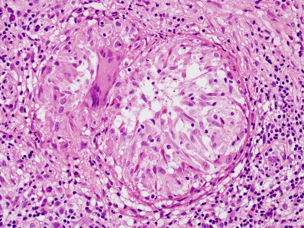 6D8 TB Tuberculosis (tuberculoma, Case 6) H&E 18