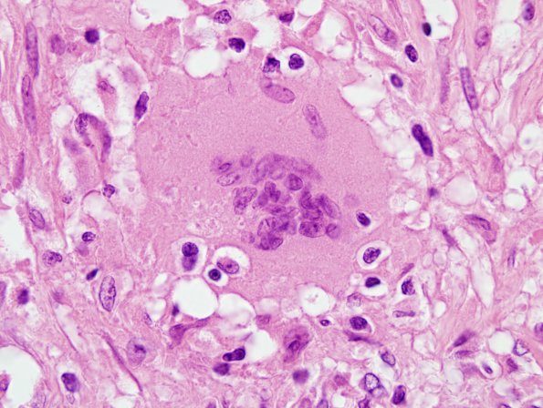 6D9 TB Tuberculosis (tuberculoma, Case 6) H&E 100X 1