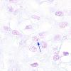 6E1 TB Tuberculosis (tuberculoma, Case 6) AFB 1 cropped copyA