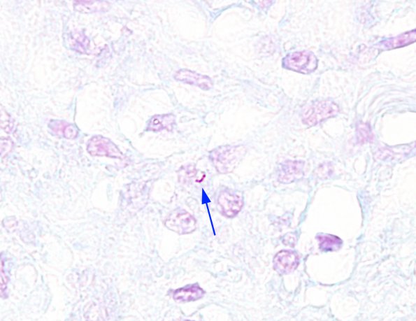 6E1 TB Tuberculosis (tuberculoma, Case 6) AFB 1 cropped copyA