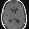 7A1 TB Tuberculous meningoencephalitis (Case 7) T1 W 3 - Copy