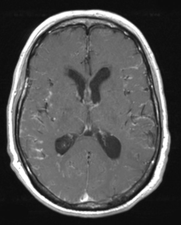 7A1 TB Tuberculous meningoencephalitis (Case 7) T1 W 3 - Copy