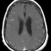 7A2 TB Tuberculous meningoencephalitis (Case 7) T1 W 4 - Copy