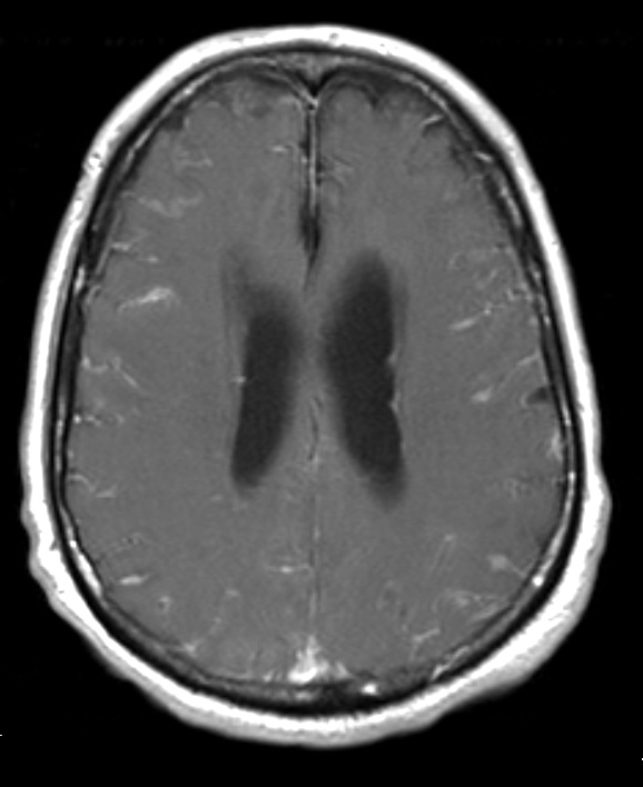 7A2 TB Tuberculous meningoencephalitis (Case 7) T1 W 4 - Copy