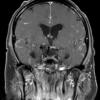 7A3 TB Tuberculous meningoencephalitis (Case 7) T1 W 6 - Copy