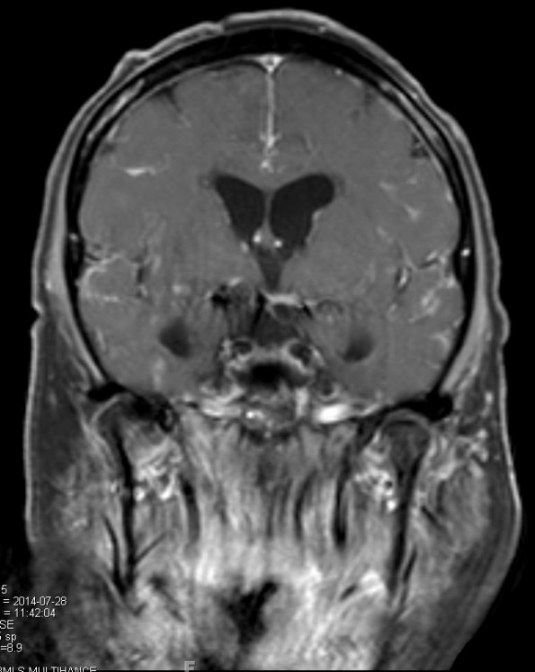 7A3 TB Tuberculous meningoencephalitis (Case 7) T1 W 6 - Copy