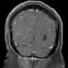 7A4 TB Tuberculous meningoencephalitis (Case 7) T1 W 7 - Copy