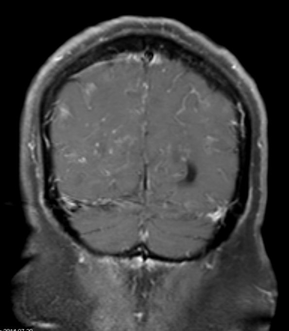 7A4 TB Tuberculous meningoencephalitis (Case 7) T1 W 7 - Copy