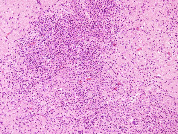 7B1 Tuberculous meningoencephalitis (Case 7) H&E 15